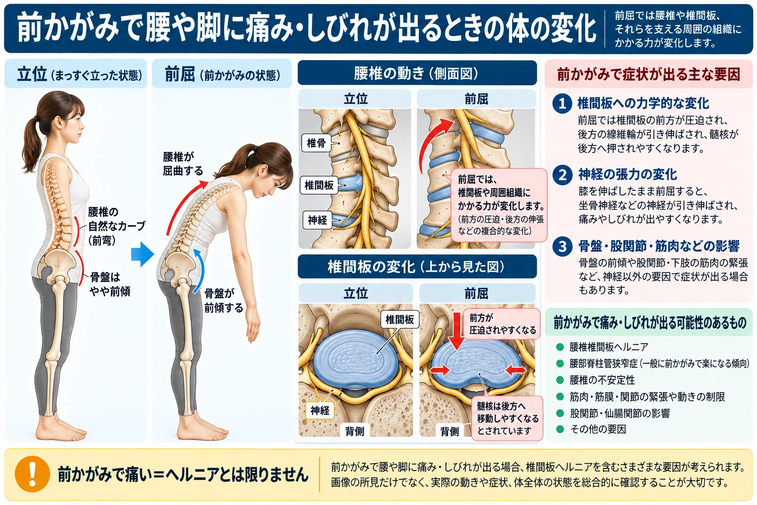 前かがみで腰椎・椎間板・骨盤がどのように動き、腰や脚の痛み・しびれが出ることがあるかを示した解剖図