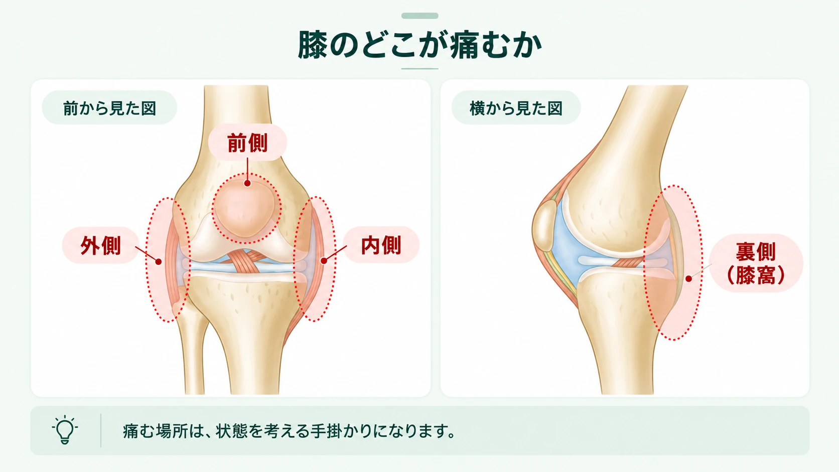 膝の前側・内側・外側・裏側（膝窩）など、痛みが現れる場所を正面と側面の図で示した模式図