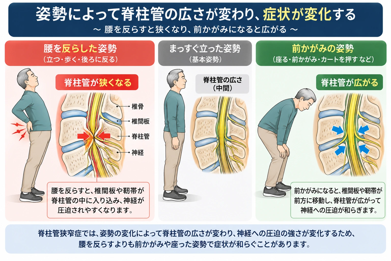 腰を反らす、まっすぐ立つ、前かがみの3姿勢による脊柱管の広さと症状の違いを比較した模式図