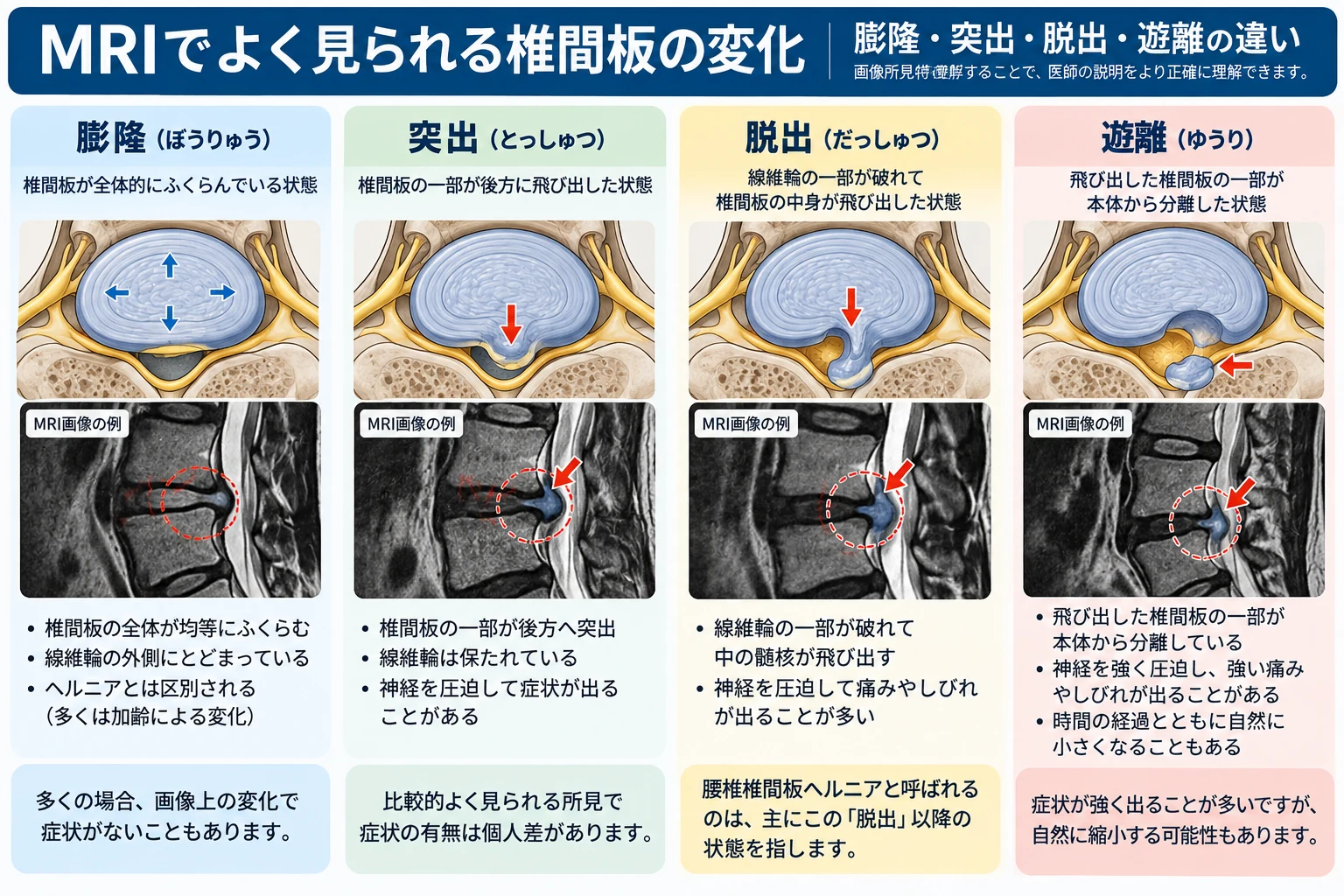 MRIでみられる椎間板の膨隆・突出・脱出・遊離の違いを、解剖図とMRI画像例で比較した図