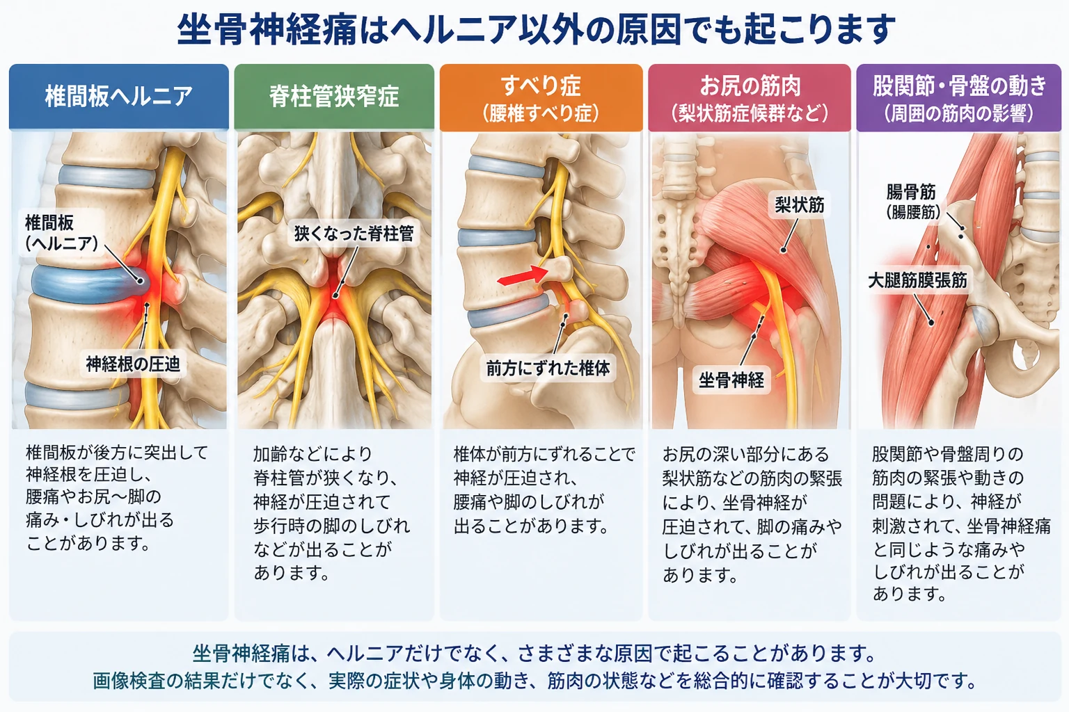坐骨神経痛が椎間板ヘルニアだけでなく、脊柱管狭窄症、腰椎すべり症、お尻周囲の筋肉、股関節や骨盤周囲の状態でもみられることを示した解剖図