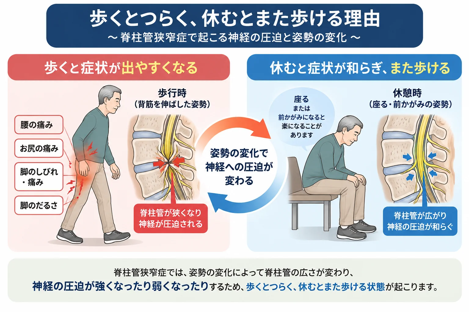 脊柱管狭窄症に伴う症状と姿勢の関係を比較した模式図。歩行時は脚の痛みやしびれが出やすく、座位や前かがみでは和らぐことがある