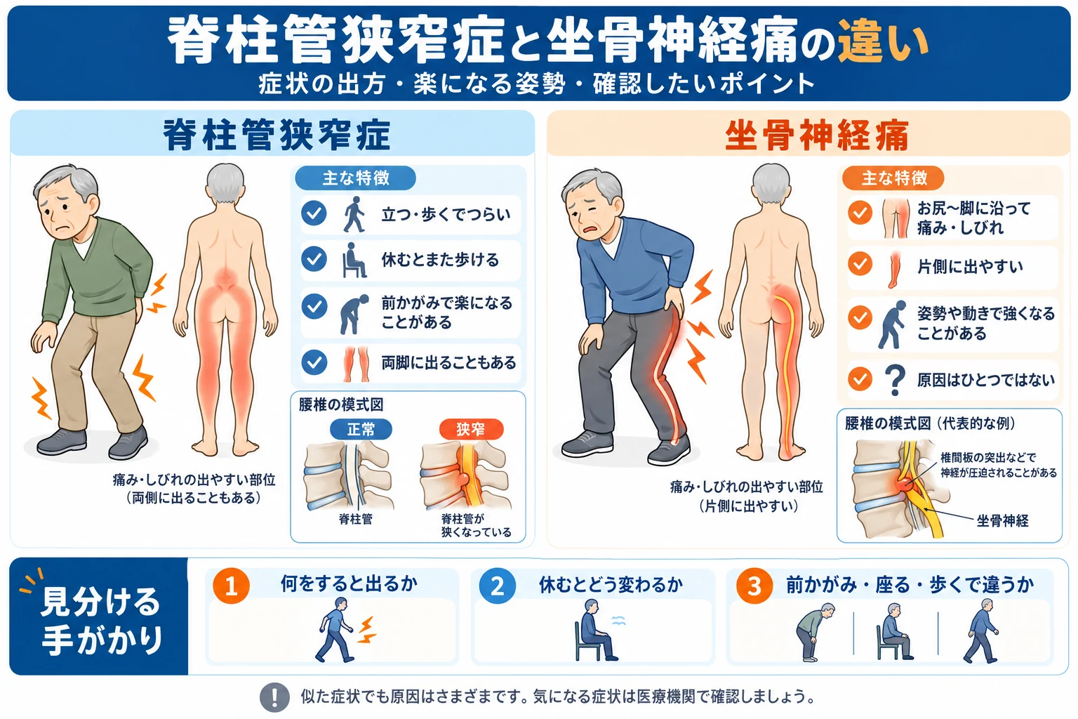 脊柱管狭窄症と坐骨神経痛の症状の出方、歩行時のつらさ、姿勢による変化を左右で比較した説明図